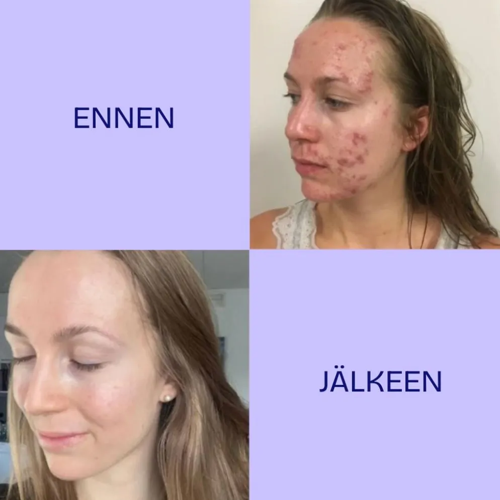 Twistbe Jojoba-teepuu kasvoöljy 30ml
